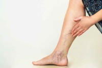 Современные методы лечения варикоза и забота о ногах